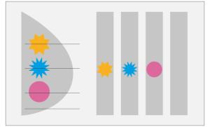 Tomosynthèse : l’image des trois lésions est dissociée